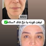 کلینیک ژل بوتاکس لیزر فیل بیوتی
