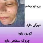 فیشیال و پاکسازی پوست