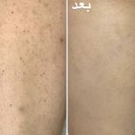 اجاره دستگاه لیزر(مجموعه لیزر کارلیا)