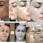 کرم ضدلک وسفیدکننده vip