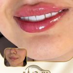 کلینیک هانیل | فیلر و بوتاکس شرق