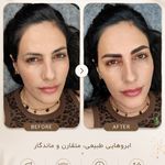 مرکز میکروبلیدینگ شیدینگ ریموو اسکالپ