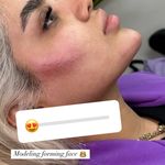 ژل و بوتاکس مونالیزا