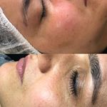خدمات تخصصی پاکسازی و فیشال پوست