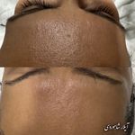 فیشال و پاکسازی پوست  آیلار شاهوردی