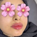 خانه لیزر فیلر و بوتاکس ثنا