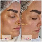 فیشال و پاکسازی پوست درنواب