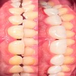 دندانپزشکی دکتر کاتبی کامپوزیت لمینیت