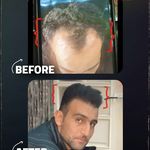 کلینیک کاشت مو زمرد