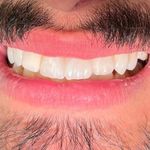 دندانپزشکی دکتر کاتبی کامپوزیت لمینیت