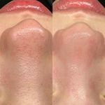 فیشال و پاکسازی تخصصی پوست سودی ثبتی
