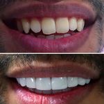 دندانپزشکی، کاشت ایمپلنت فوری و لمینتی