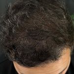 میکرواسکالپ درمان کم پشتی مو حسنی