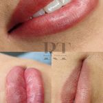 مرکز میکروبلیدینگ شیدینگ ریموو اسکالپ