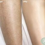 اجاره دستگاه لیزر(مجموعه لیزر کارلیا)