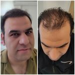 بهترين كاشت ابرو و مو مشهد خانم معين