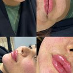 کلینیک ژل بوتاکس لیزر فیل بیوتی