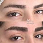 میکروبلیدینگ ملیکادولتی