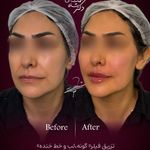 پوست مو فیلر جوانساز دکتر شاه نعمت الهی