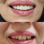 دندانپزشکی دکتر کاتبی کامپوزیت لمینیت