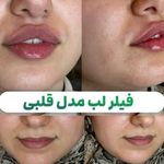 فیلر و بوتاکس  بیوتی