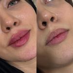 لیزر مو زائد و ژل و بوتاکس وجوانسازی