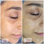 فیشال و پاکسازی پوست درنواب