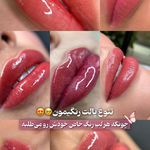 مرکز تخصصی شیدینگ لب بدون درد در قم