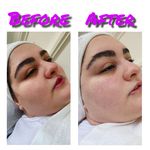 فیشال درمانی و پاکسازی پوست میرجلیلی