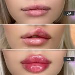 تزریق ژل و بوتاکس .انزیم