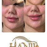 کلینیک هانیل | فیلر و بوتاکس شرق