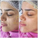 فیشال و پاکسازی پوست درنواب