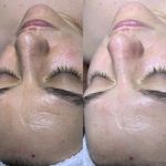 فیشال و پاکسازی تخصصی پوست سودی ثبتی