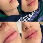 کلینیک ژل بوتاکس لیزر فیل بیوتی