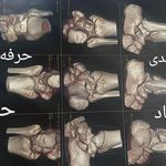 شکسته بندی، طب سنتی استادحکیم