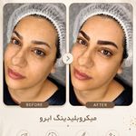 مرکز میکروبلیدینگ شیدینگ ریموو اسکالپ