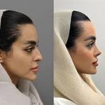 جراحی بینی غزل گودرزی