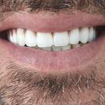 دندانسازی الماس