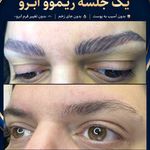 مرکز تخصصی ریموو تتو صورت گیلان رشت