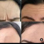 خدمات تخصصی تزریق ژل و بوتاکس