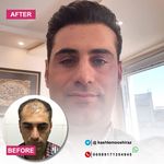 مرکز کاشت مو حسینی