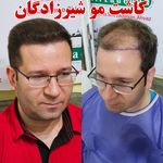 کلینیک کاشت مو مریم شیرزادگان