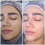 فیشال و پاکسازی پوست درنواب