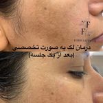 خدمات فیشیال و آموزش تخصصی پوست فروغ