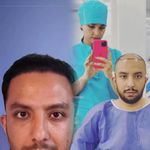 کاشت مو -کاشت ابرو -کاشت ریش شکیبا