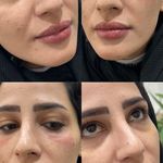 کلینیک ژل بوتاکس لیزر فیل بیوتی
