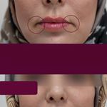 کلینیک ژل بوتاکس لیزر فیل بیوتی