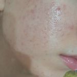 فیشال درمانی و پاکسازی پوست میرجلیلی