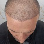 کاشت مو سر ابرو اردبیل و پارس آباد مرادی