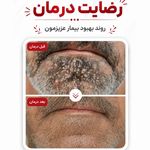 Iran.h.p.v